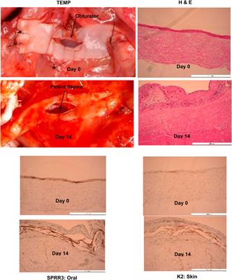 Reconstruction of functional human lips utilizing a prelaminated flap